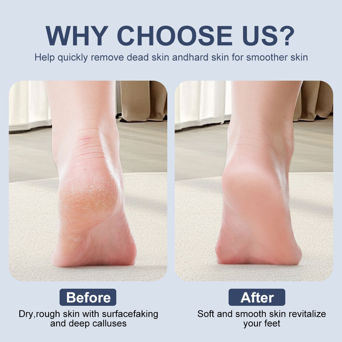 Electric Callus Remover